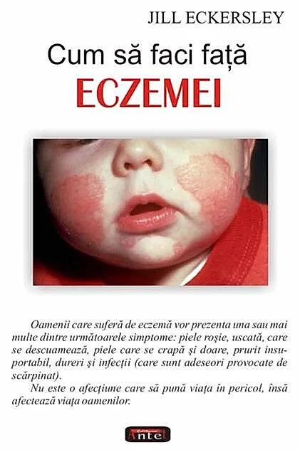 Cum să faci faţă eczemei